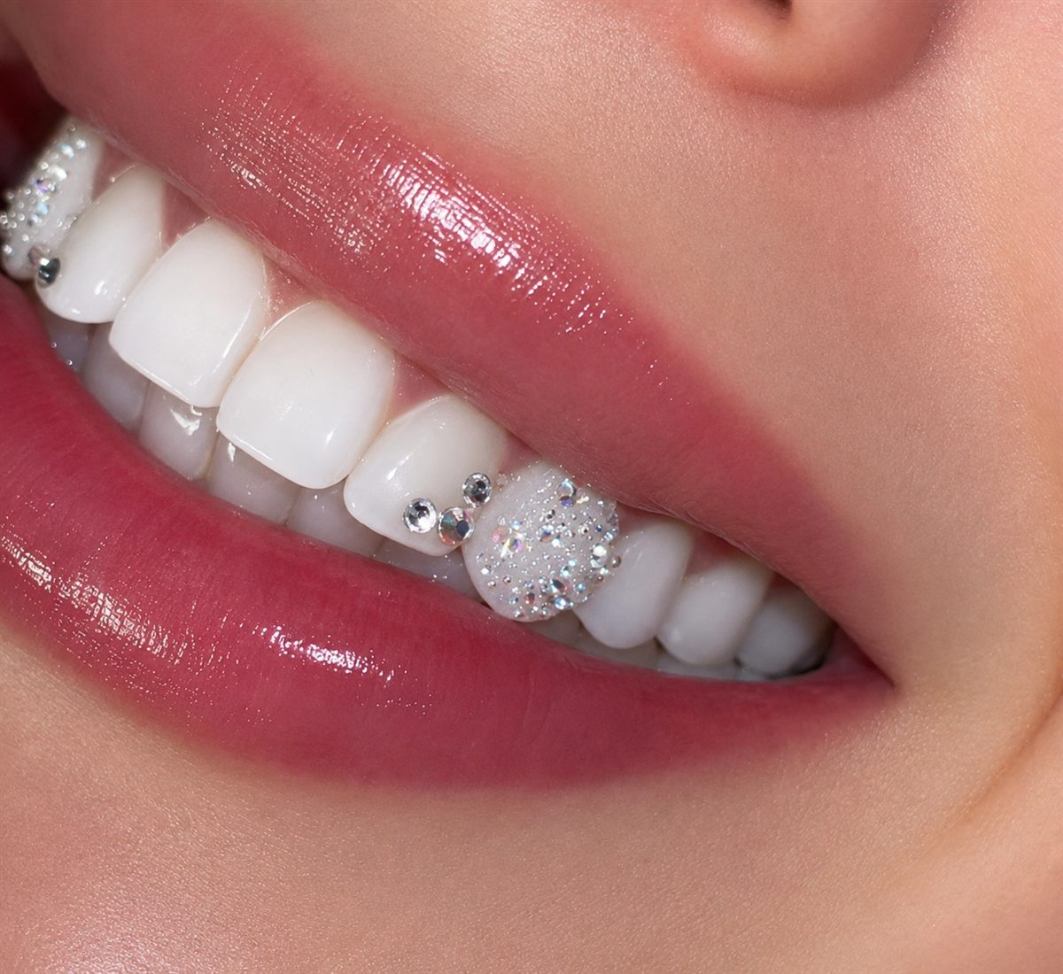 Tooth Gems Explained: What They Are and How They Are Applied