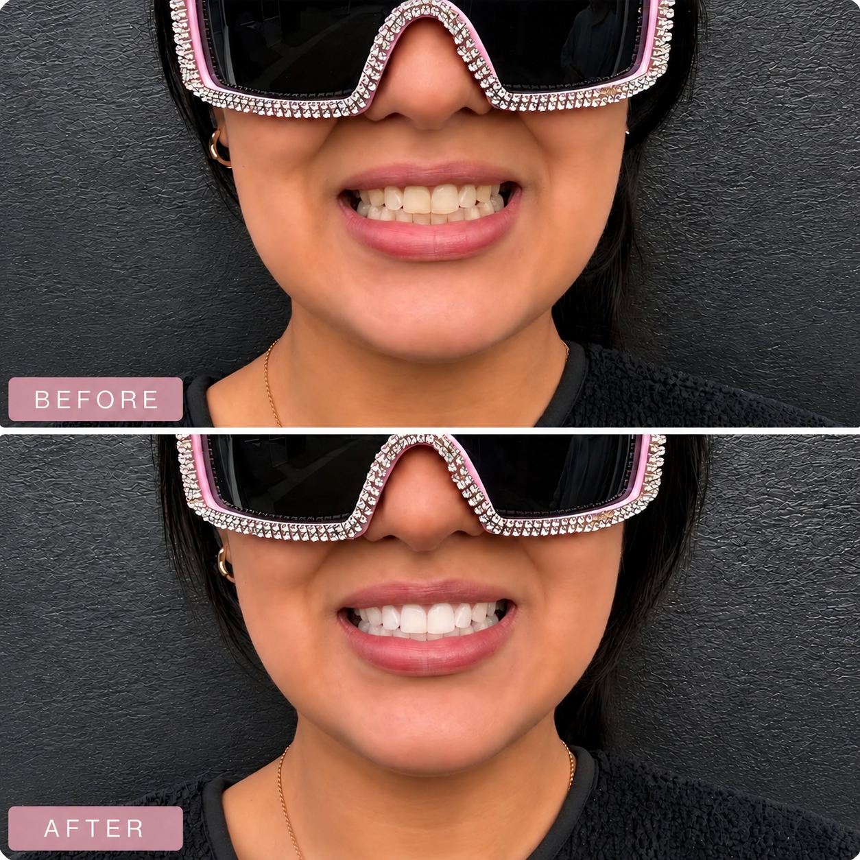 Whitening and tooth gem work at Medusa Studio