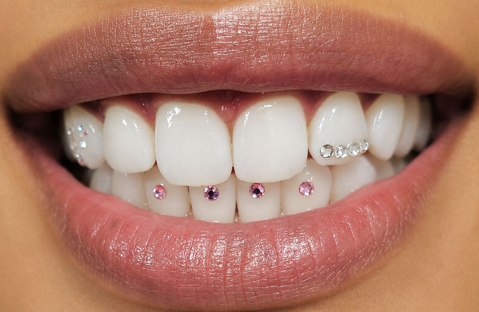 Whitening and tooth gem work at Medusa Studio
