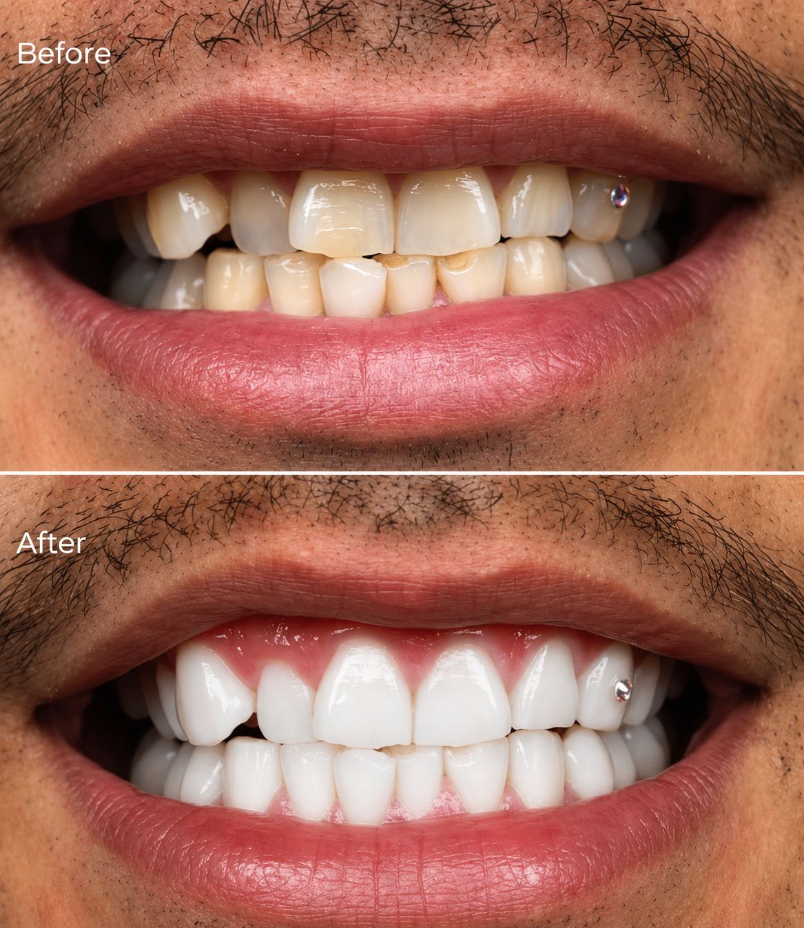 Whitening and tooth gem work at Medusa Studio